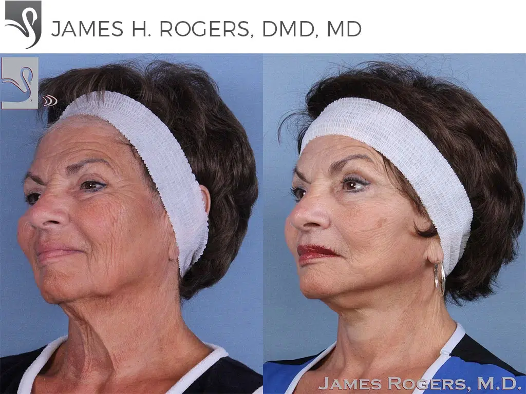 Before and After Image: Face Lift Case #62473 - left-front-oblique