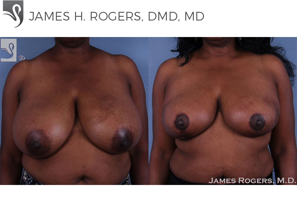 Before and After Image: Female Breast Reduction Case #62515 - front