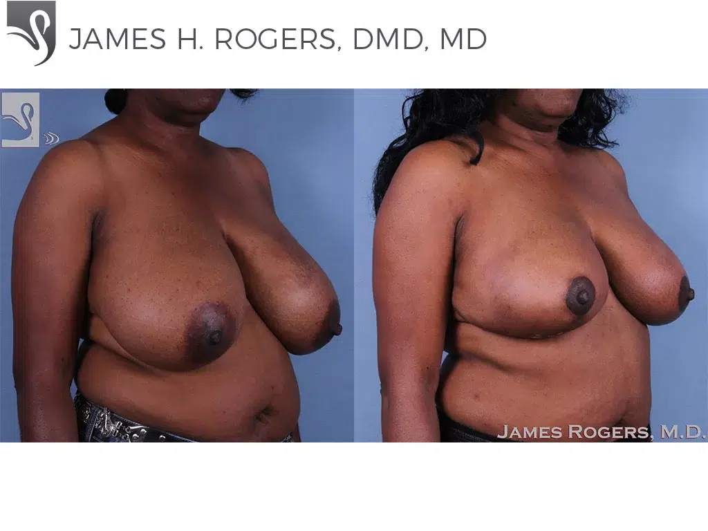 Before and After Image: Female Breast Reduction Case #62515 - right-front-oblique