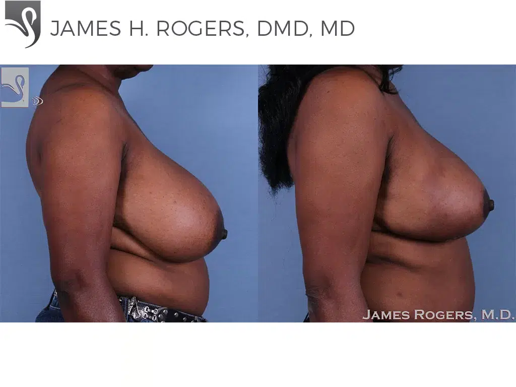 Before and After Image: Female Breast Reduction Case #62515 - right-side