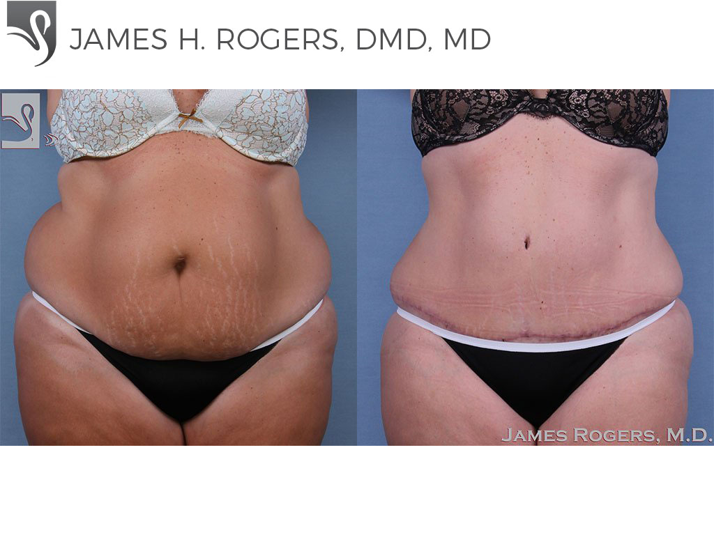 Before and After Image: Abdominoplasty (Tummy Tuck) Case #62604 - front
