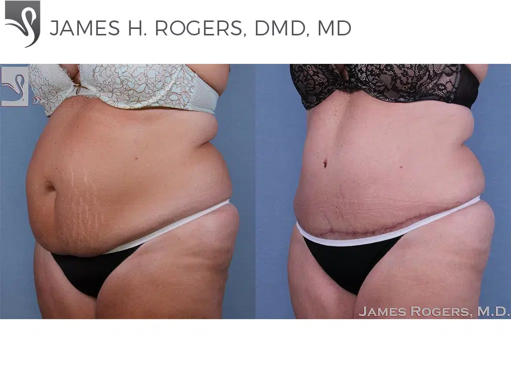 Before and After Image: Abdominoplasty (Tummy Tuck) Case #62604 - left-front-oblique