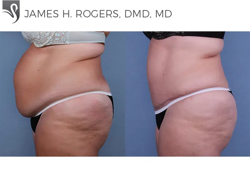 Before and After Image: Abdominoplasty (Tummy Tuck) Case #62604 - left-side