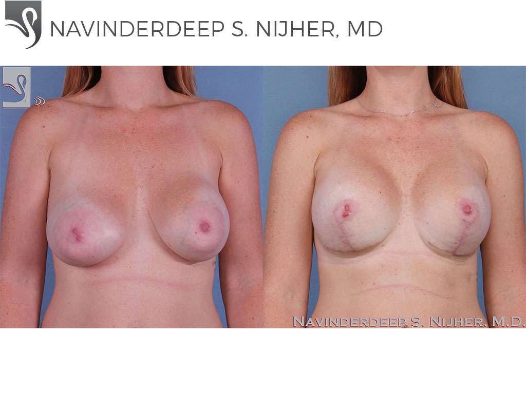 Before and After Image: Breast Revisions Case #62612 - front