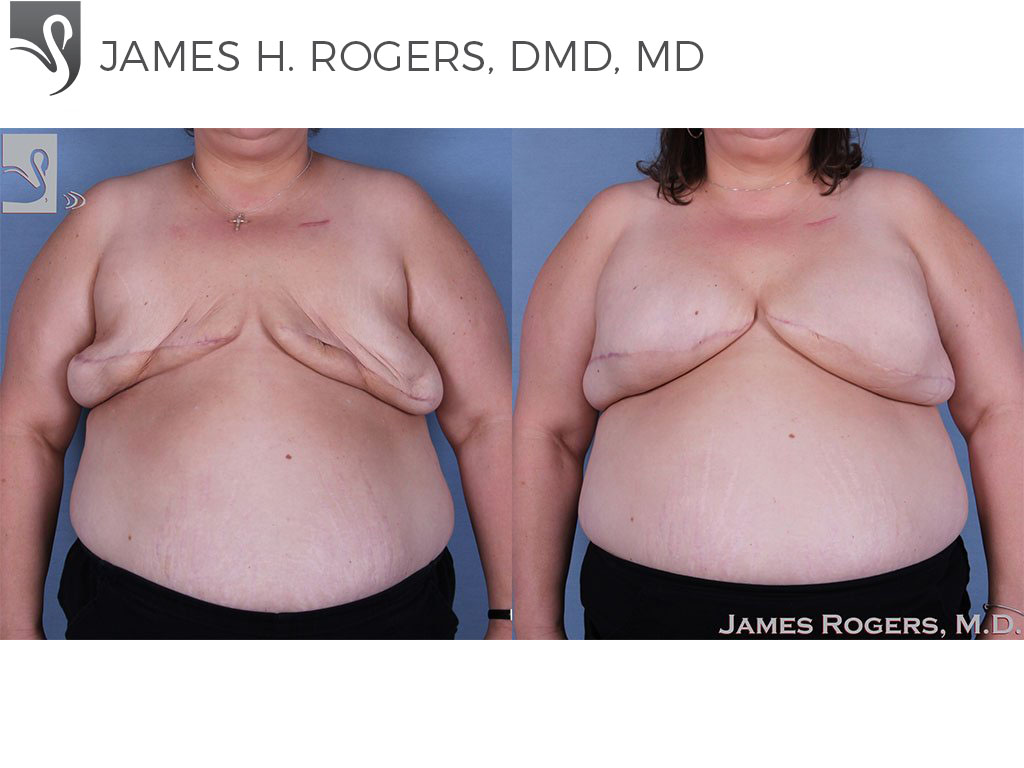 Before and After Image: Breast Reconstruction Case #30932 - front