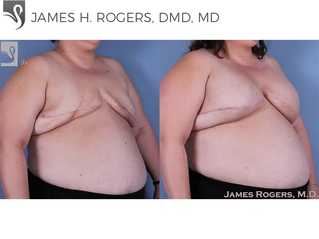 Before and After Image: Breast Reconstruction Case #30932 - right-front-oblique