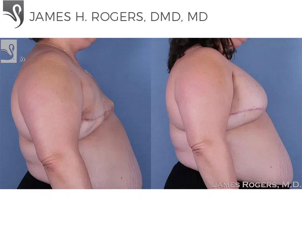 Before and After Image: Breast Reconstruction Case #30932 - right-side