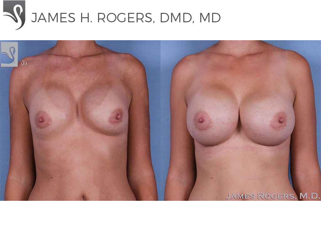 Before and After Image: Breast Revisions Case #62755 - front
