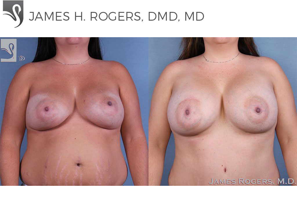Before and After Image: Breast Revisions Case #62794 - front