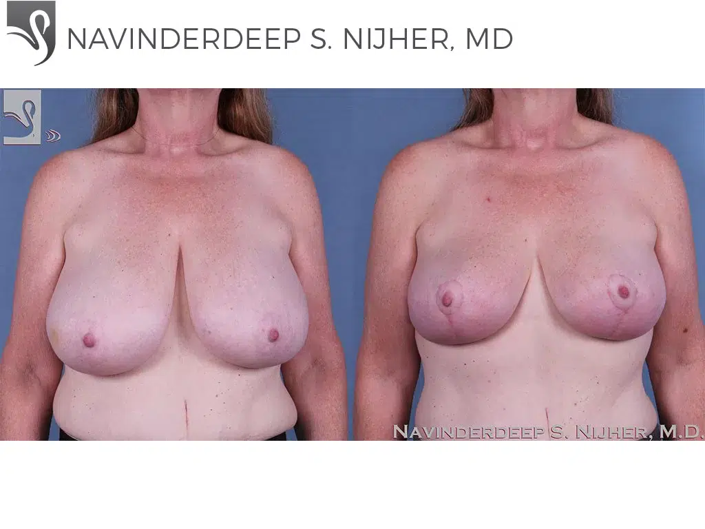 Before and After Image: Female Breast Reduction Case #62944 - front
