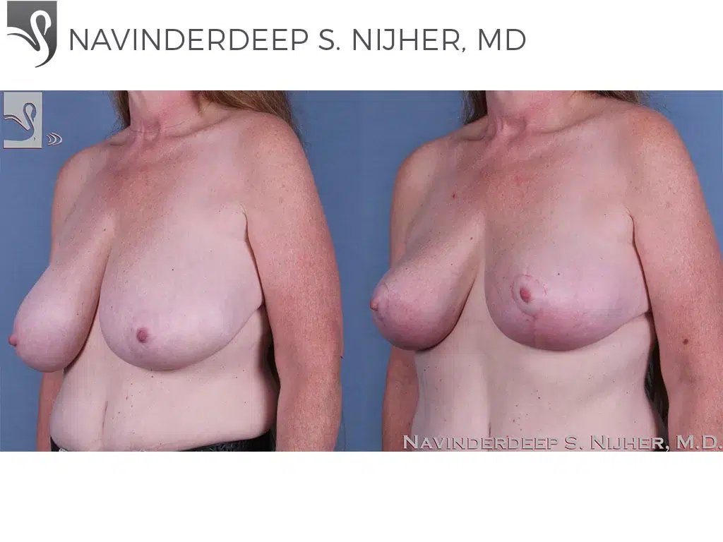 Before and After Image: Female Breast Reduction Case #62944 - left-front-oblique