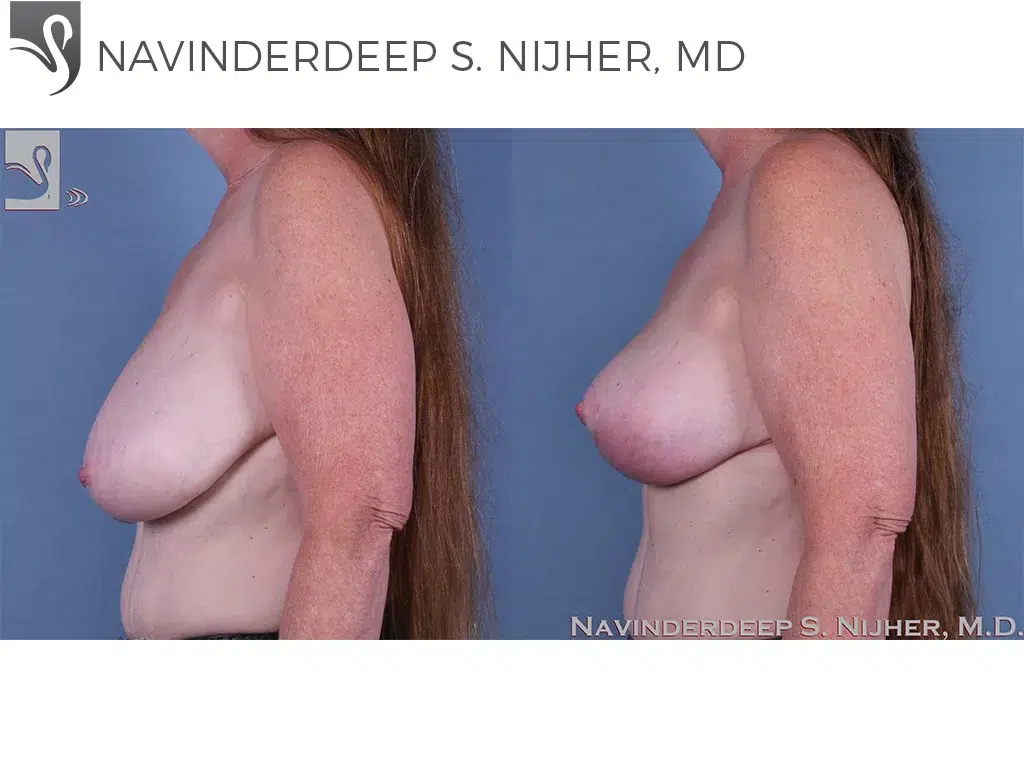 Before and After Image: Female Breast Reduction Case #62944 - left-side