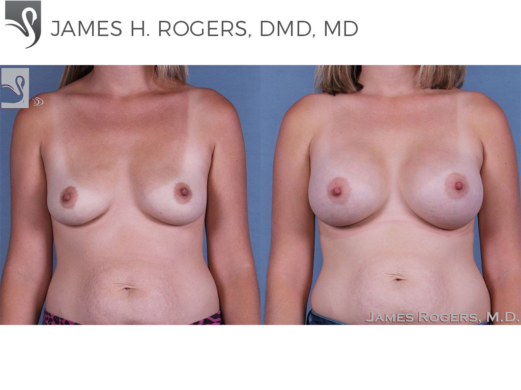 Before and After Image: Breast Augmentation Case #62978 - front