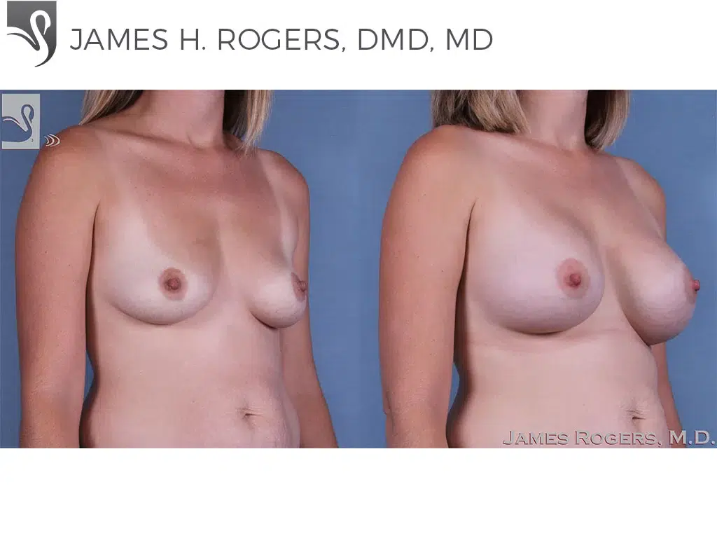 Before and After Image: Breast Augmentation Case #62978 - right-front-oblique