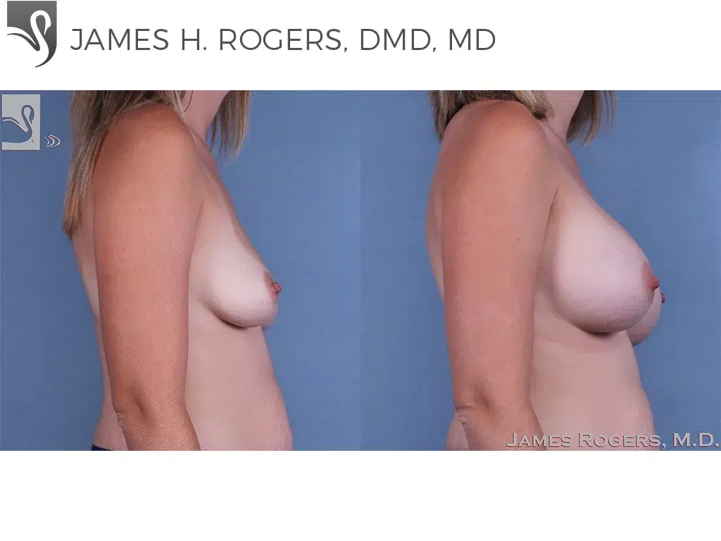 Before and After Image: Breast Augmentation Case #62978 - right-side