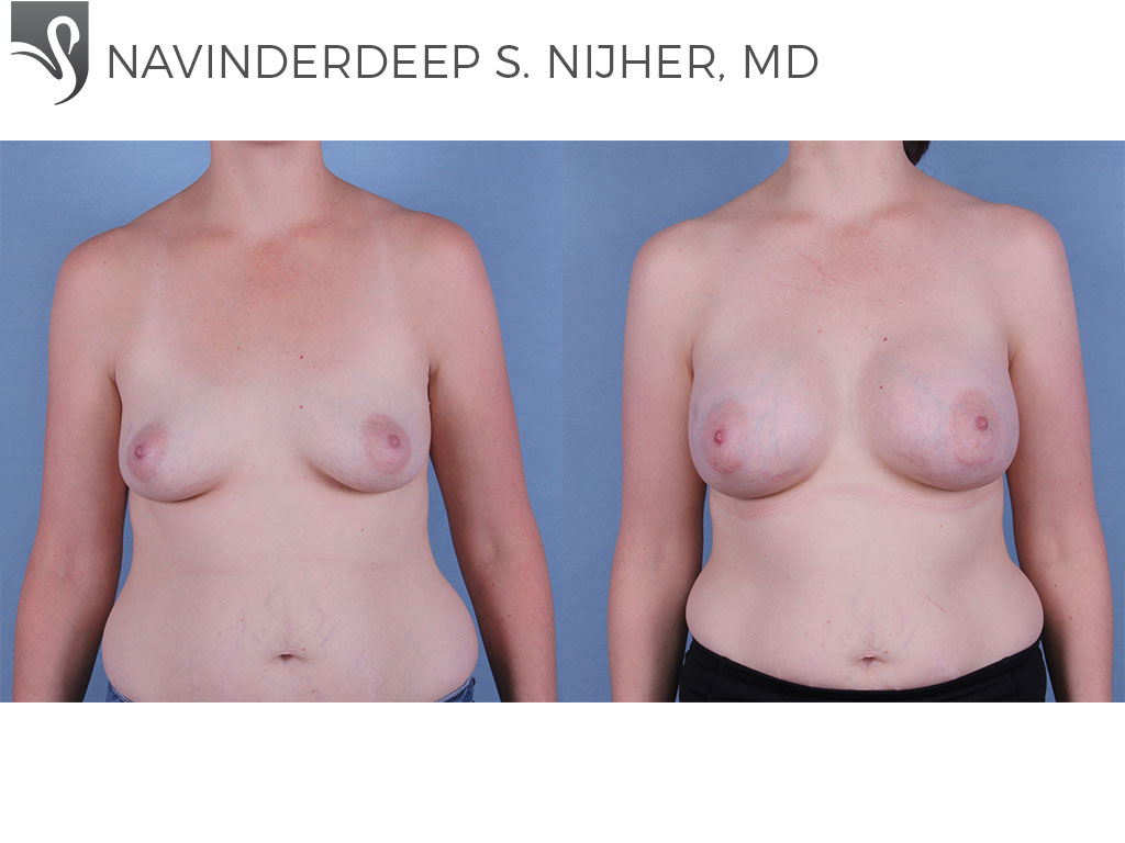 Before and After Image: Breast Augmentation Case #63129 - front