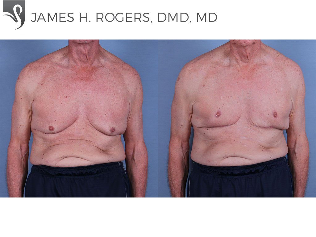 Before and After Image: Male Breast Reduction Case #63133 - front