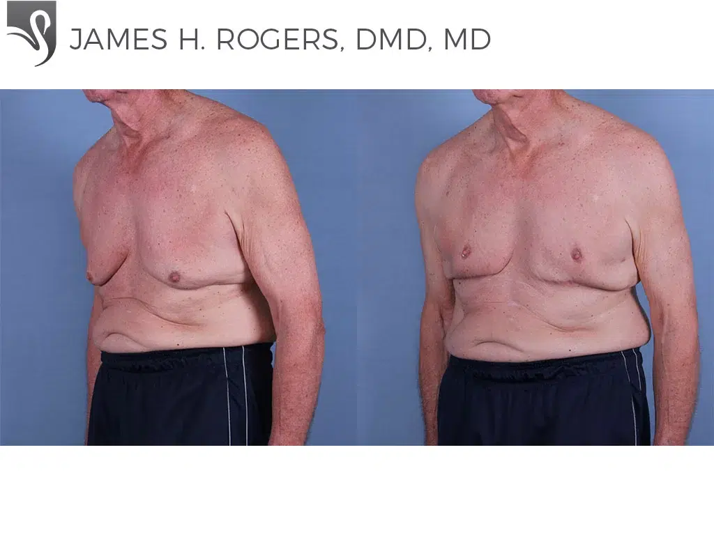Before and After Image: Male Breast Reduction Case #63133 - left-front-oblique