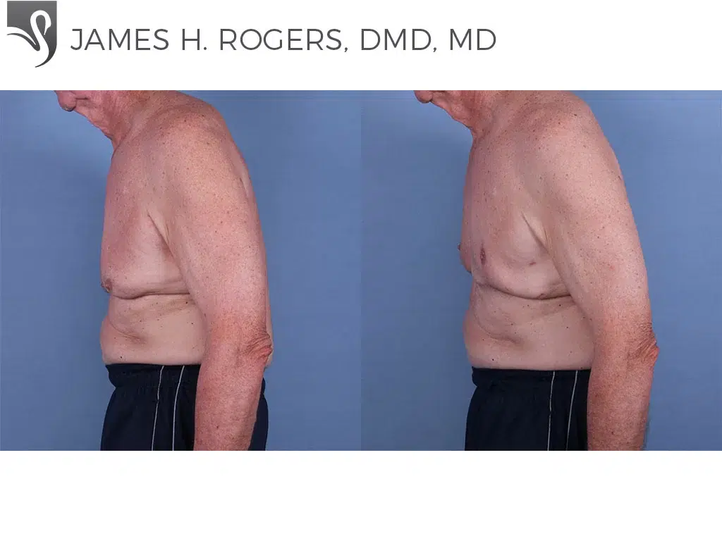 Before and After Image: Male Breast Reduction Case #63133 - left-side