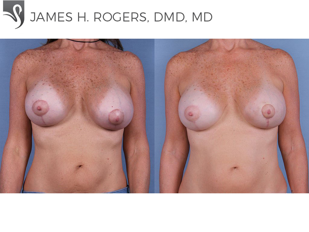 Before and After Image: Breast Revisions Case #63179 - front