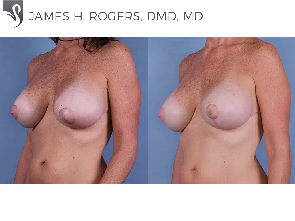 Before and After Image: Breast Revisions Case #63179 - left-front-oblique