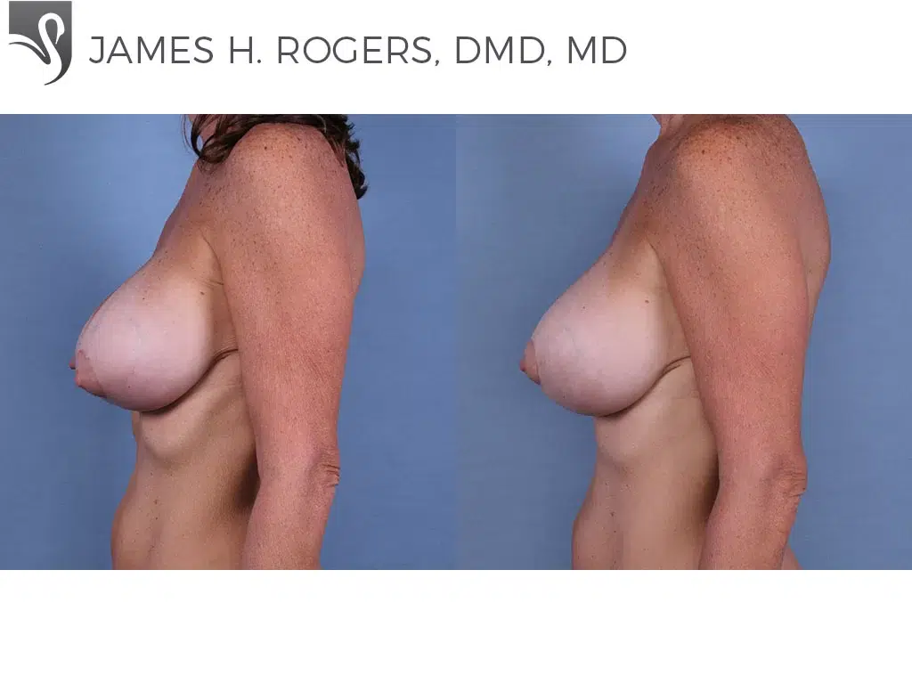 Before and After Image: Breast Revisions Case #63179 - left-side