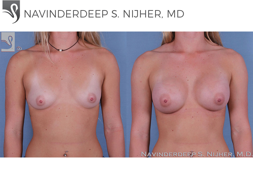 Before and After Image: Breast Augmentation Case #63196 - front
