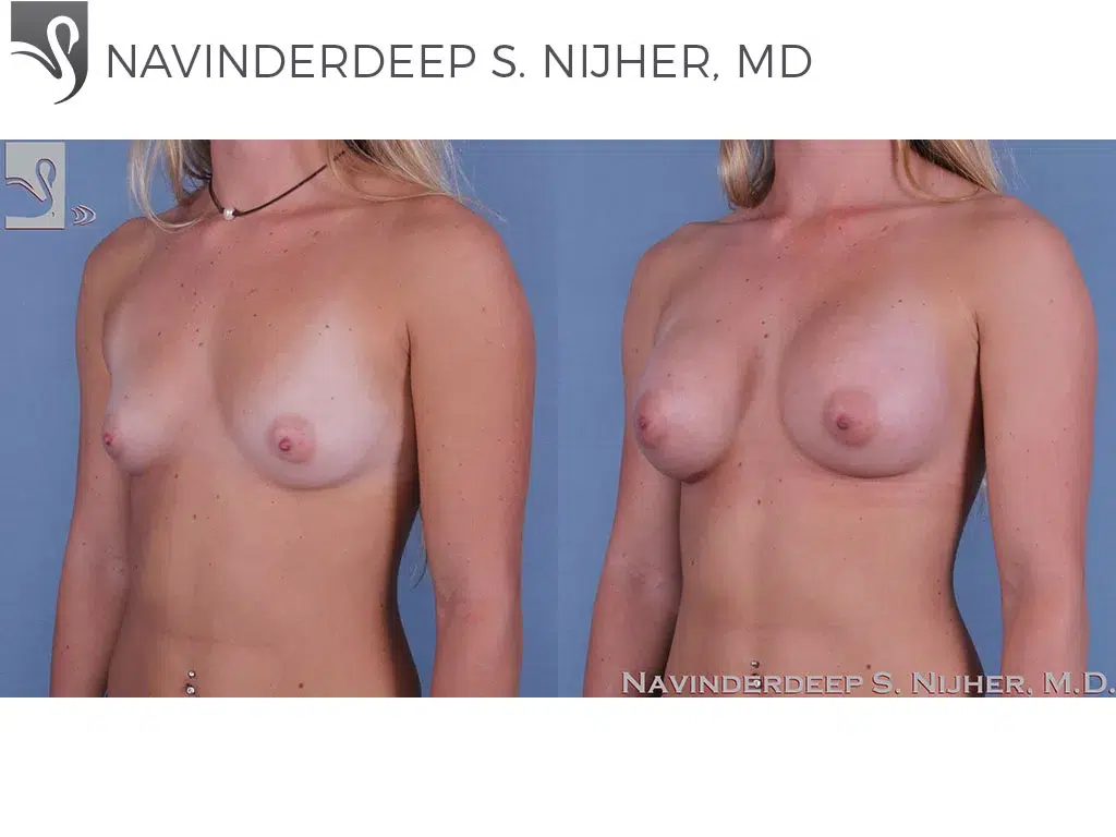 Before and After Image: Breast Augmentation Case #63196 - left-front-oblique
