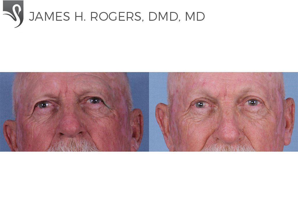 Before and After Image: Eyelid Surgery Case #63236 - front