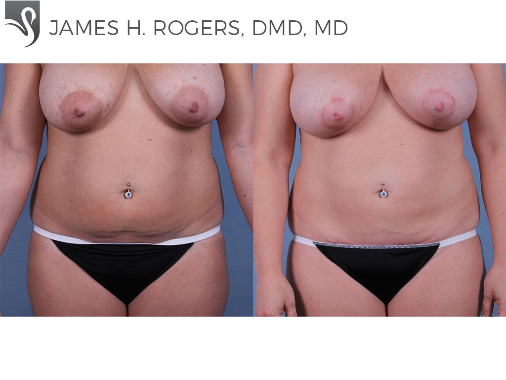 Before and After Image: Abdominoplasty (Tummy Tuck) Case #63337 - front