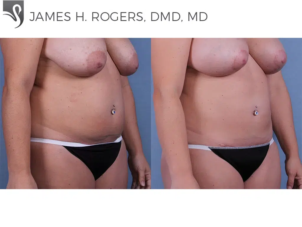 Before and After Image: Abdominoplasty (Tummy Tuck) Case #63337 - right-front-oblique