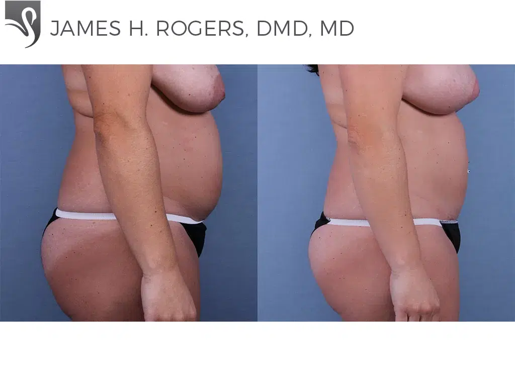 Before and After Image: Abdominoplasty (Tummy Tuck) Case #63337 - right-side
