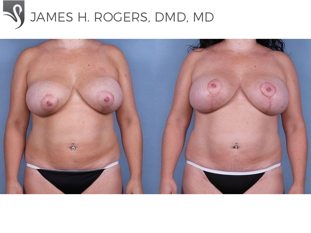 Before and After Image: Breast Revisions Case #63337 - front
