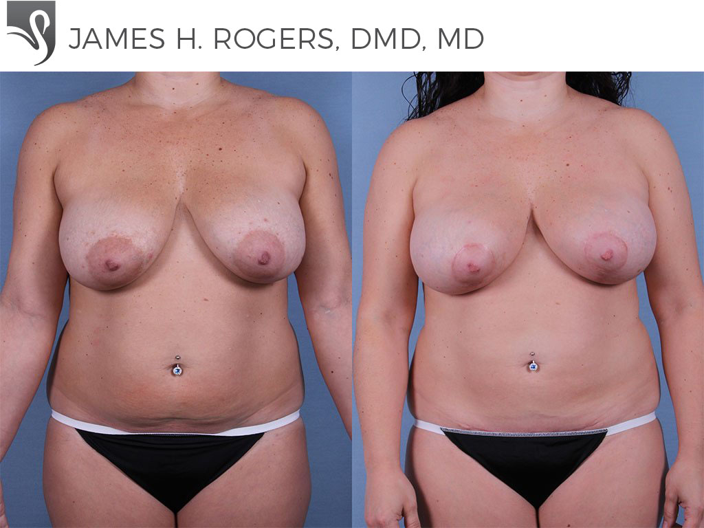 Before and After Image: Mommy Makeover Case #63337 - front