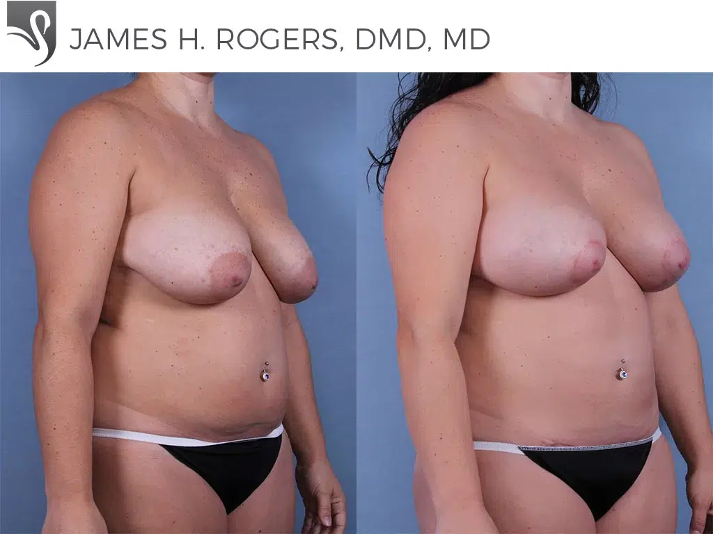 Before and After Image: Mommy Makeover Case #63337 - right-front-oblique