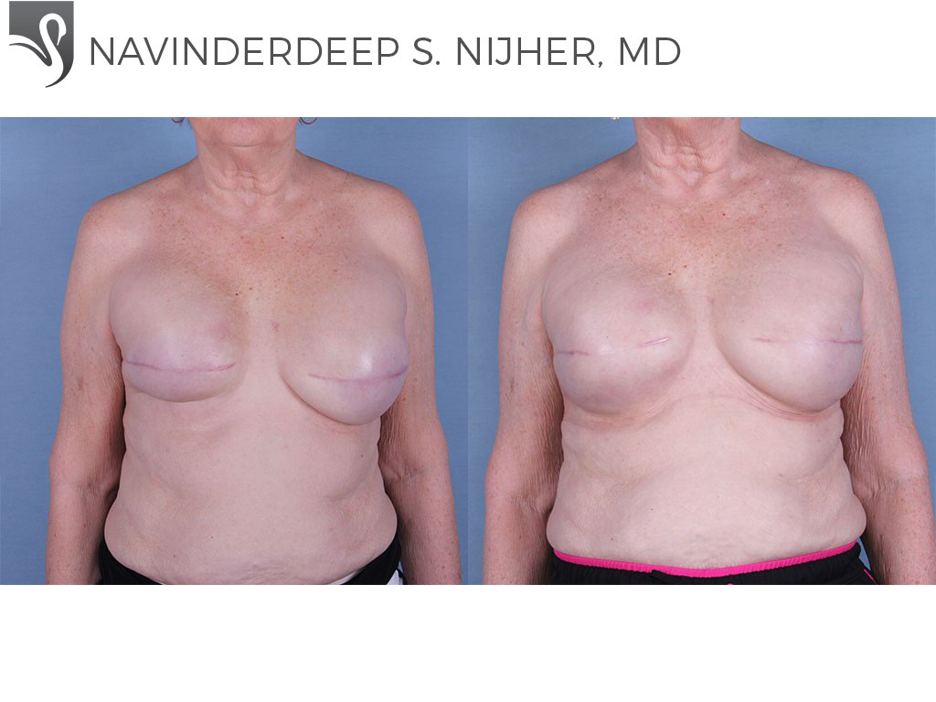 Before and After Image: Breast Reconstruction Case #63344 - front