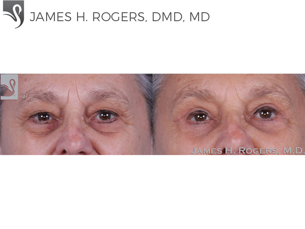 Before and After Image: Eyelid Surgery Case #63345 - front