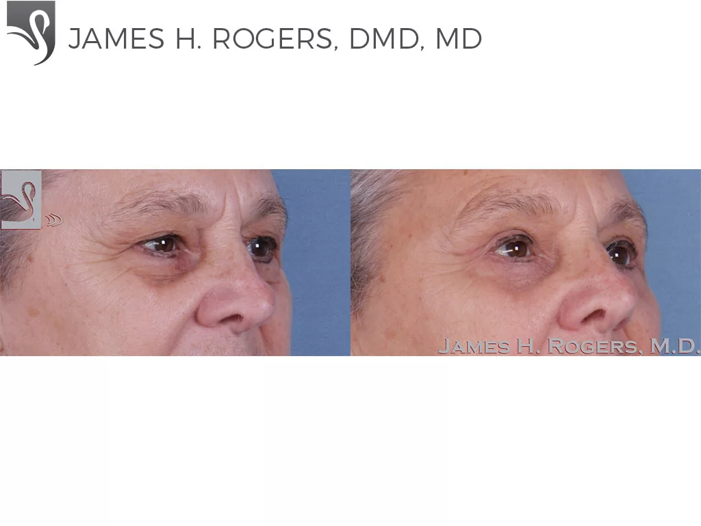 Before and After Image: Eyelid Surgery Case #63345 - right-front-oblique
