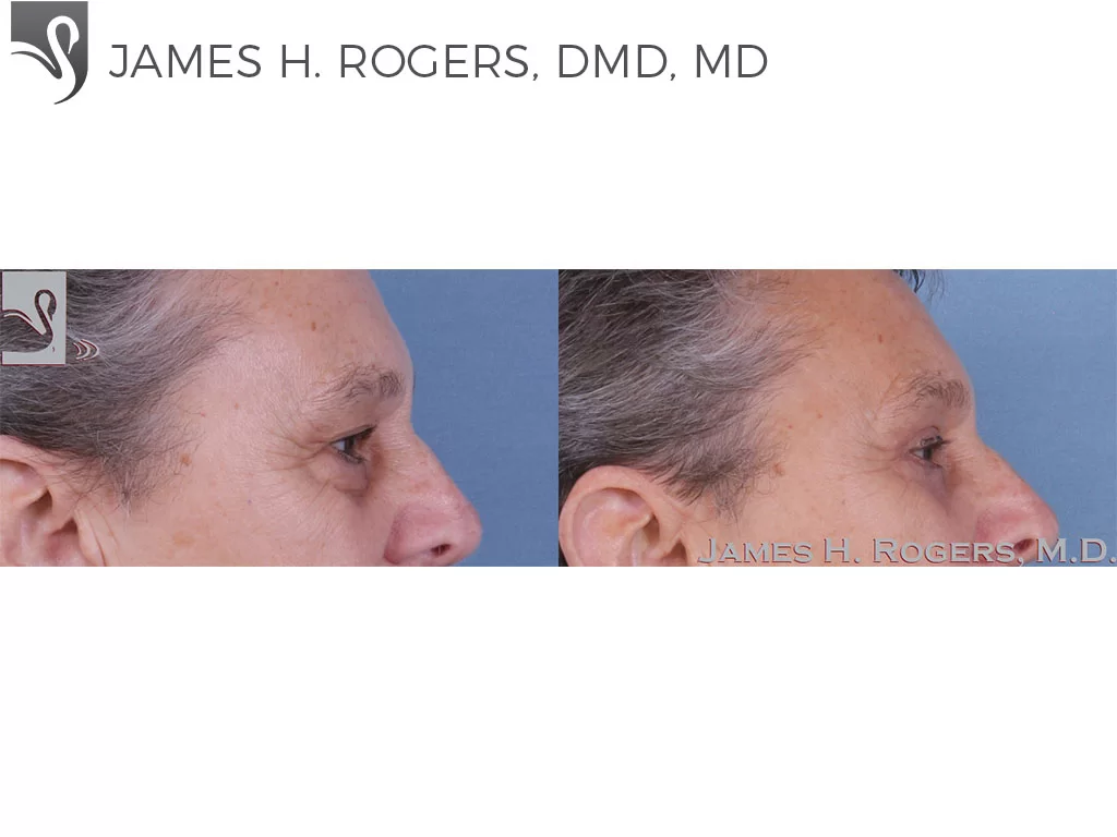 Before and After Image: Eyelid Surgery Case #63345 - right-side