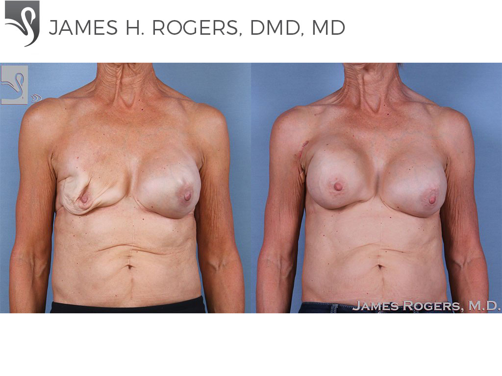 Before and After Image: Breast Reconstruction Case #63441 - front