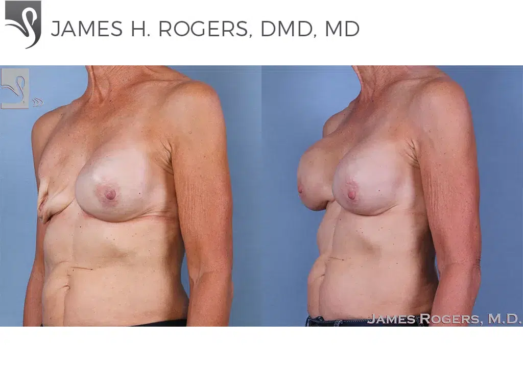 Before and After Image: Breast Reconstruction Case #63441 - left-front-oblique
