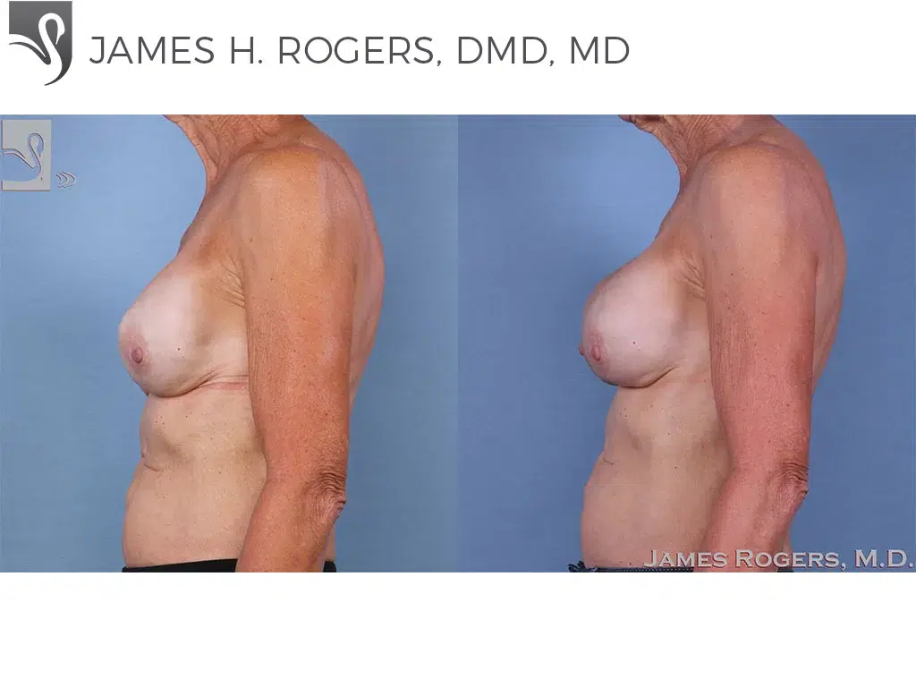 Before and After Image: Breast Reconstruction Case #63441 - left-side