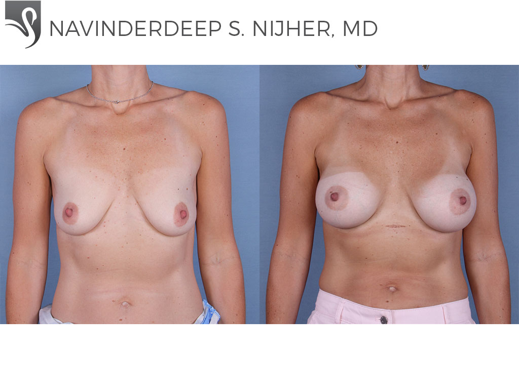 Before and After Image: Breast Augmentation Case #63491 - front