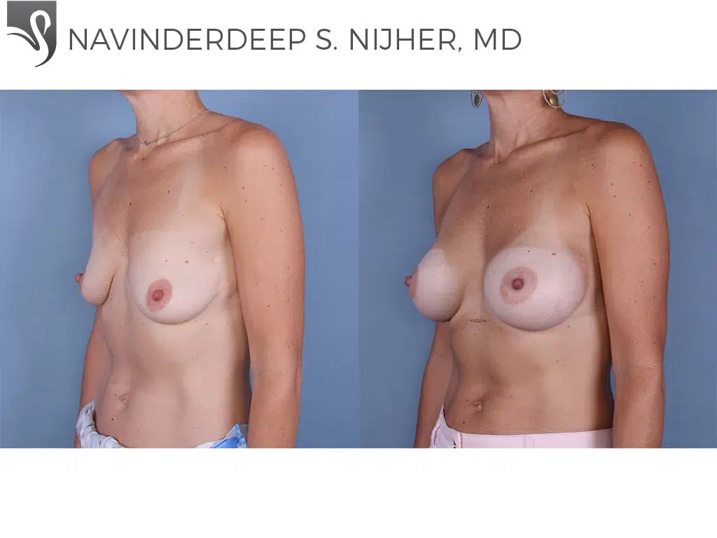 Before and After Image: Breast Augmentation Case #63491 - left-front-oblique