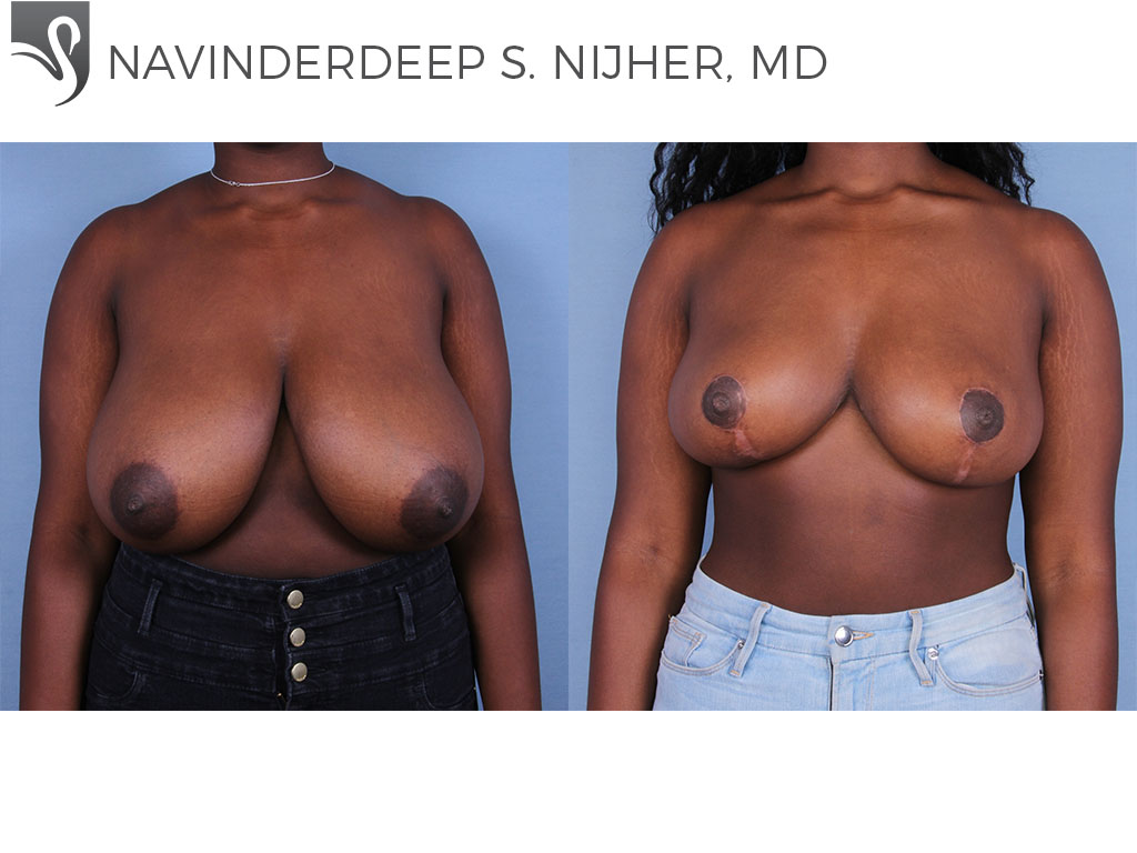 Before and After Image: Female Breast Reduction Case #63515 - front