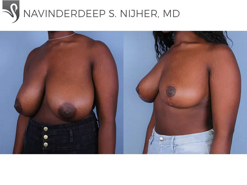 Before and After Image: Female Breast Reduction Case #63515 - left-front-oblique