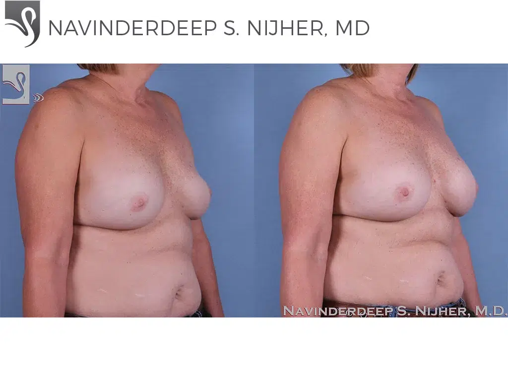 Before and After Image: Breast Revisions Case #63645 - right-front-oblique