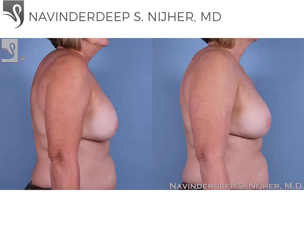 Before and After Image: Breast Revisions Case #63645 - right-side