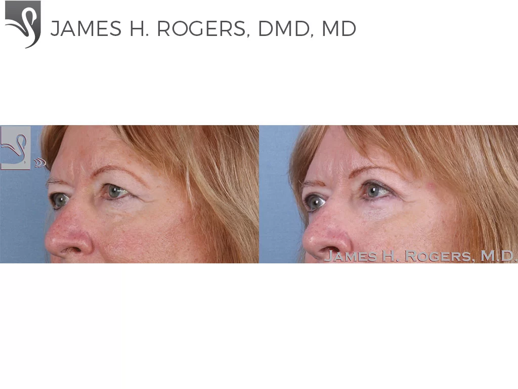 Before and After Image: Eyelid Surgery Case #63653 - left-front-oblique