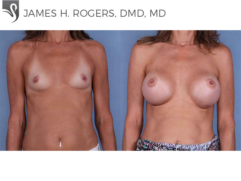 Before and After Image: Breast Augmentation Case #63809 - front
